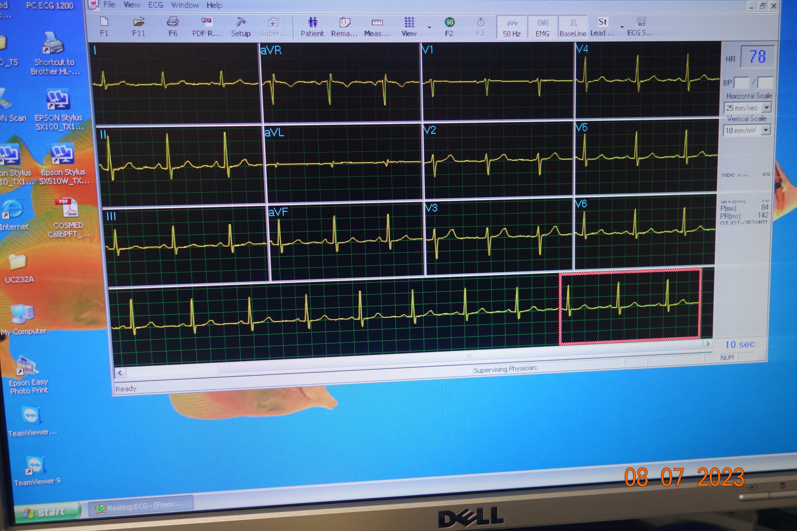 Electrocardiography (ECG)