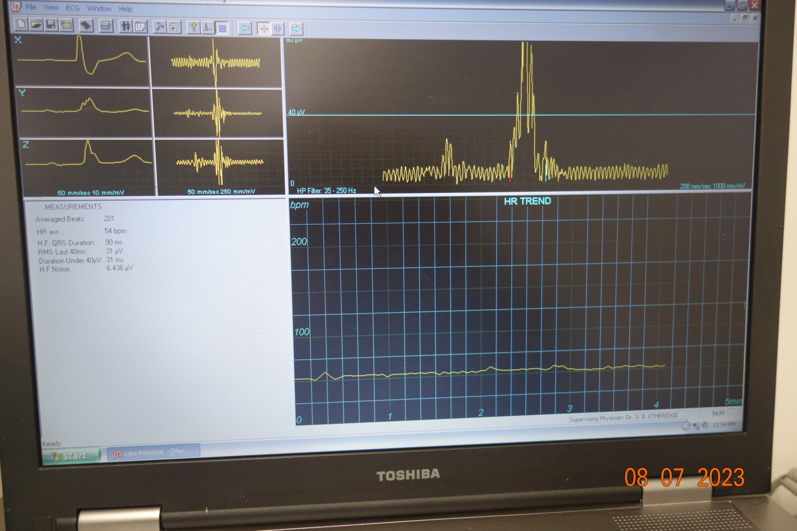 Signal Averaged ECGs